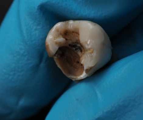 Close up of a single discolored grey tooth